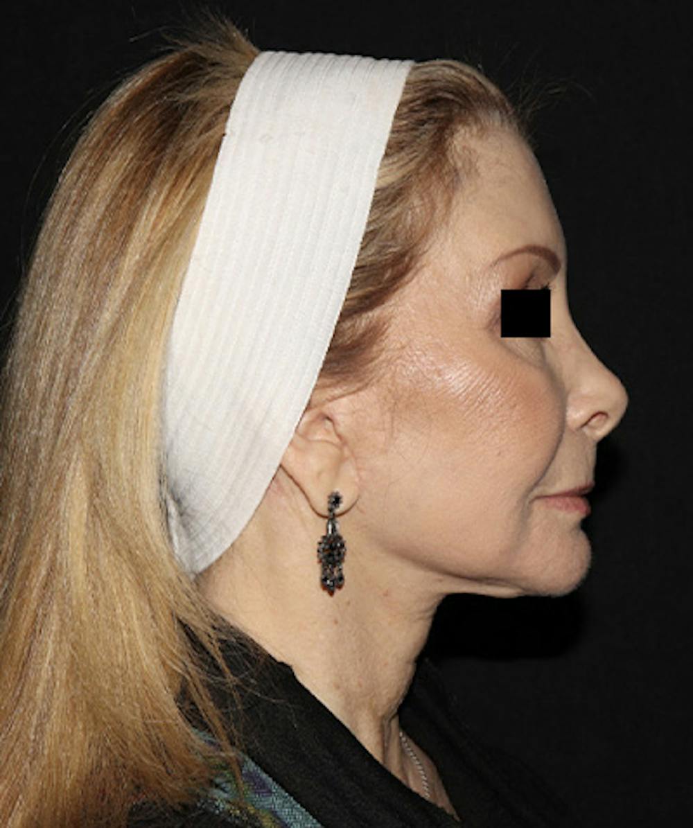 Facelift Before & After Gallery - Patient 121258980 - Image 8