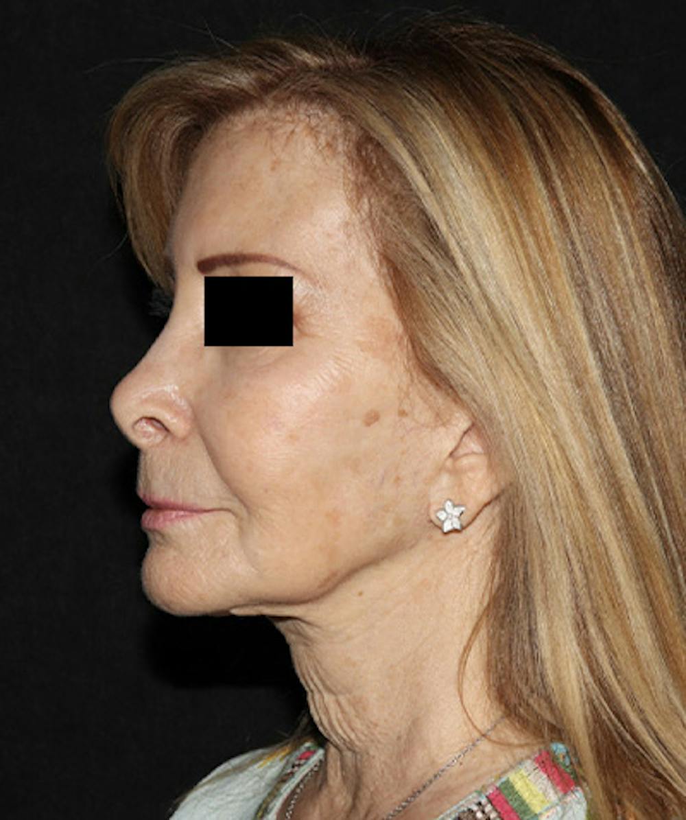 Facelift Before & After Gallery - Patient 121258980 - Image 3