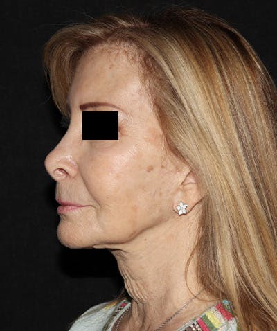 Facelift Before & After Gallery - Patient 121258980 - Image 3
