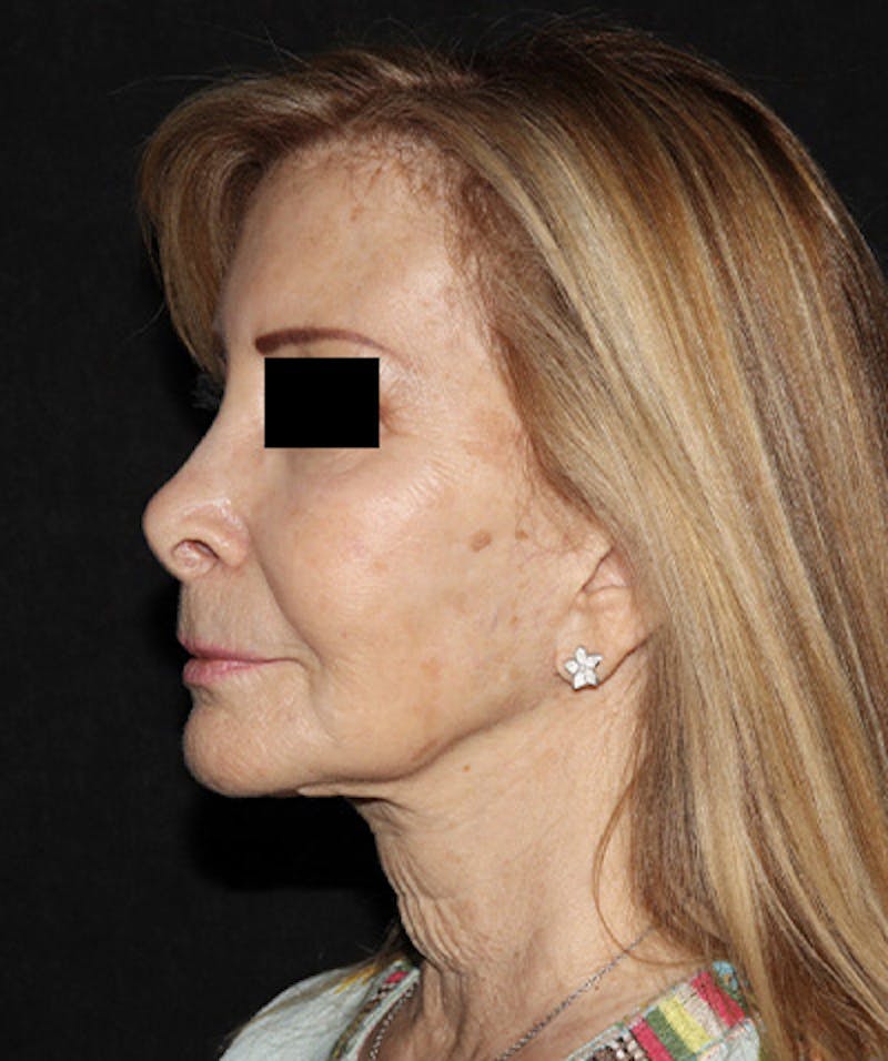 Facelift Before & After Gallery - Patient 121258980 - Image 3