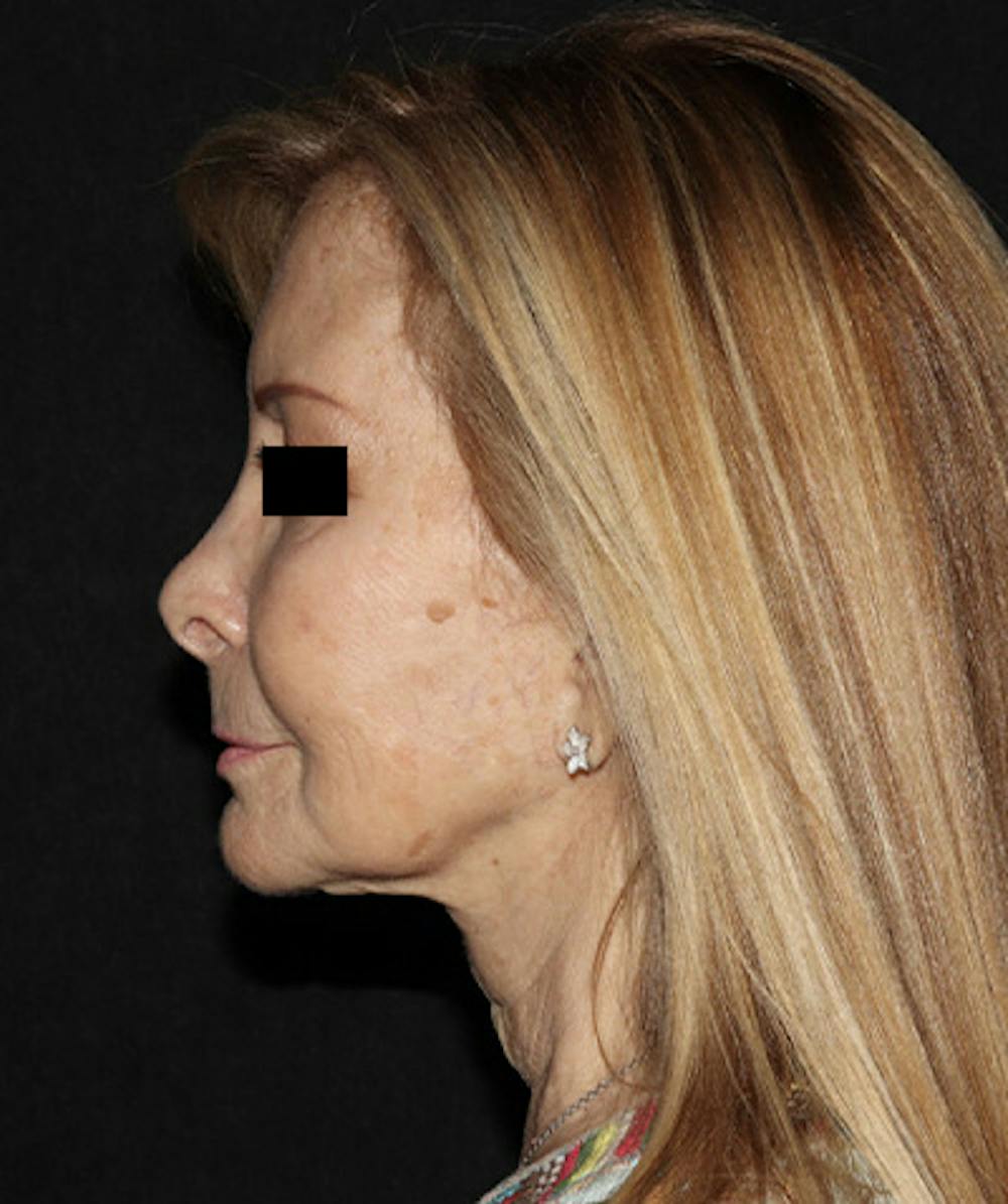 Facelift Before & After Gallery - Patient 121258980 - Image 5