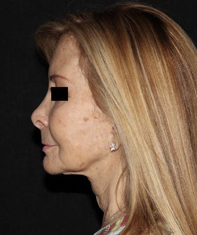 Facelift Before & After Gallery - Patient 121258980 - Image 5