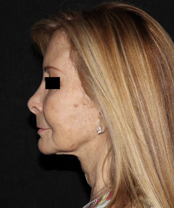 Facelift Before & After Gallery - Patient 121258980 - Image 5