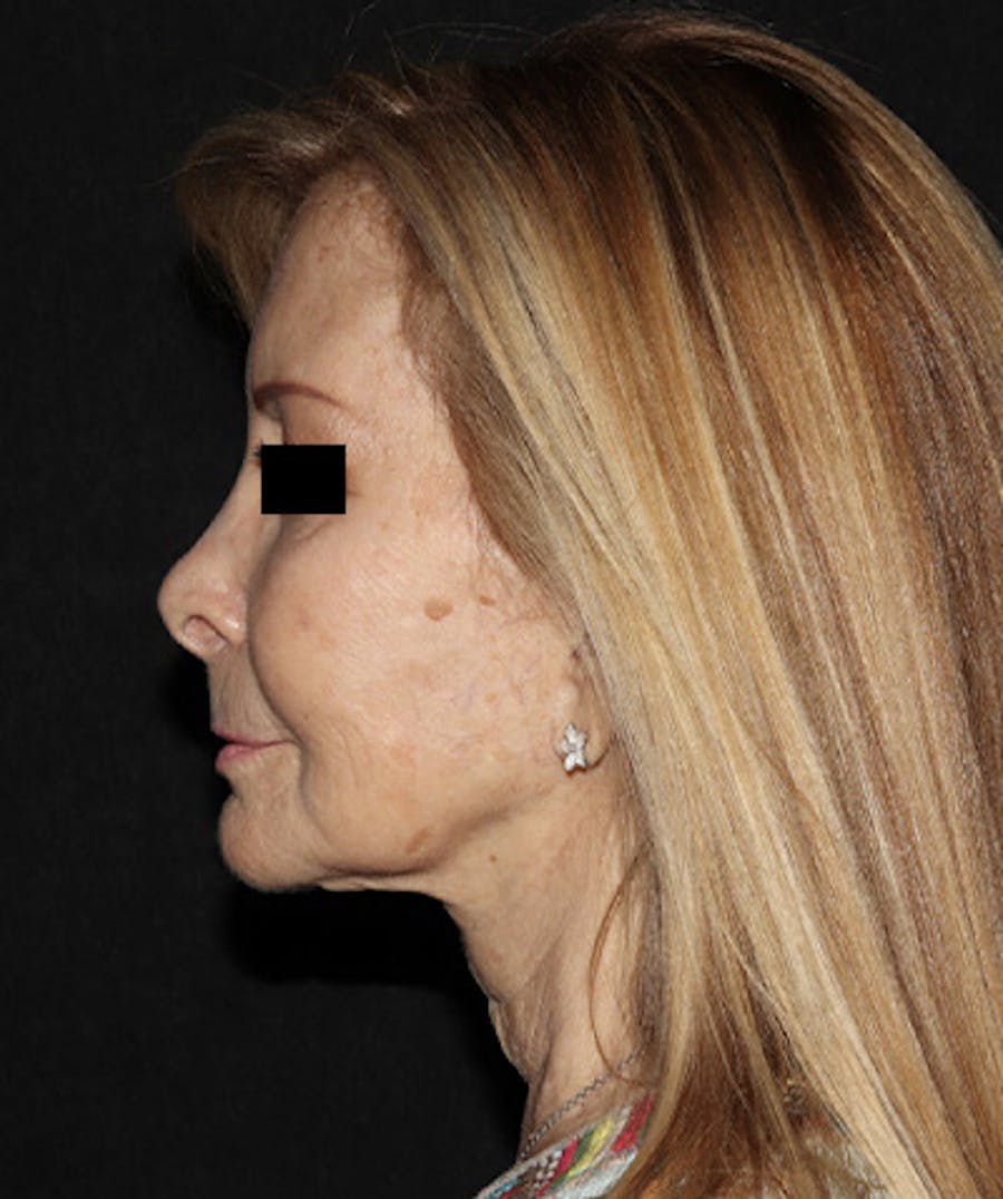 Facelift Before & After Gallery - Patient 121258980 - Image 5