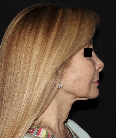 Facelift Before & After Gallery - Patient 121258980 - Image 7
