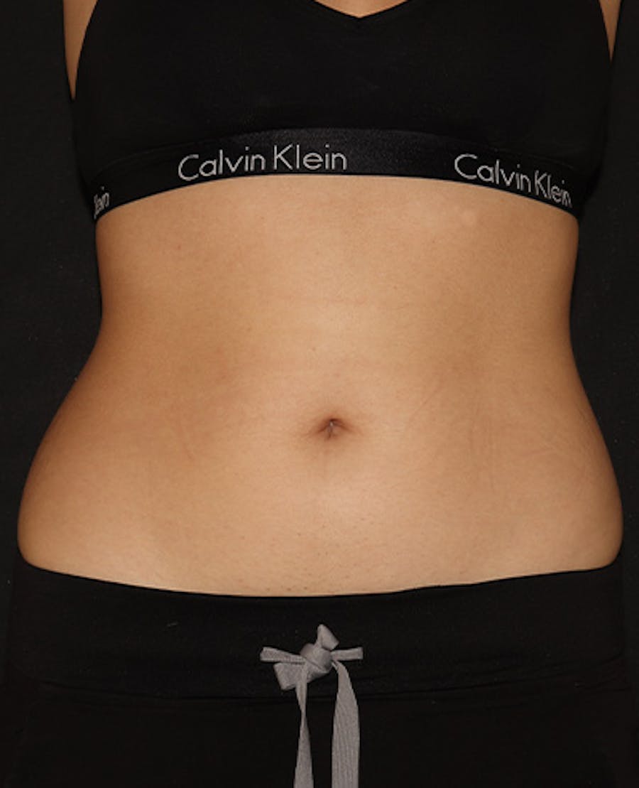 Vanquish Before & After Gallery - Patient 120754 - Image 1
