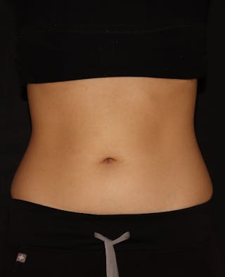 Vanquish Before & After Gallery - Patient 120754 - Image 2