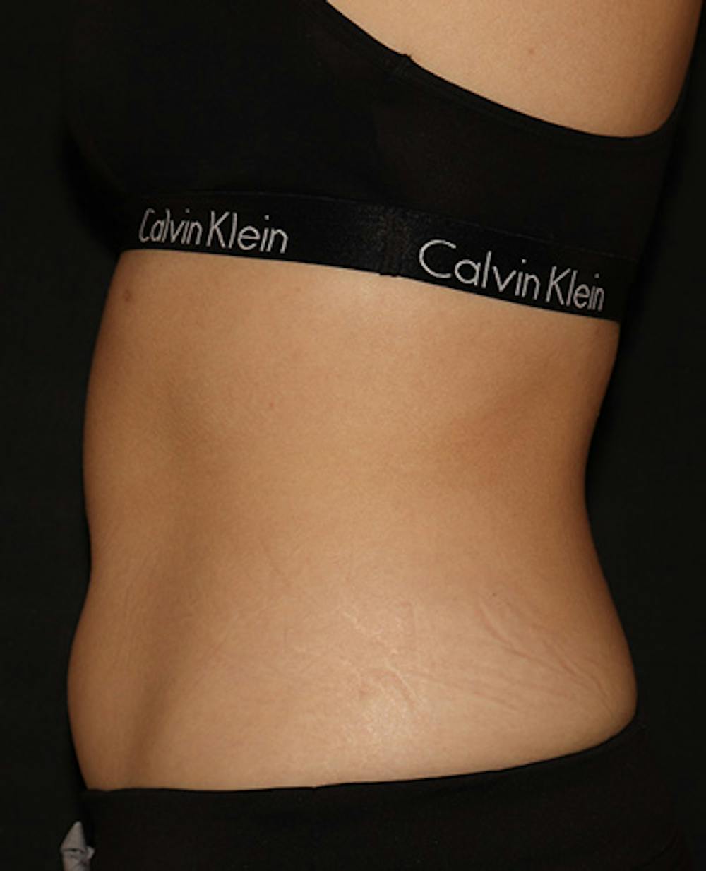 Vanquish Before & After Gallery - Patient 120754 - Image 3