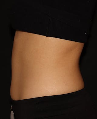 Vanquish Before & After Gallery - Patient 120754 - Image 4