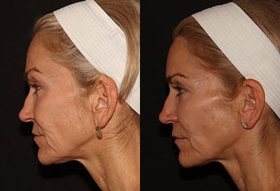 EMFACE Before & After Gallery - Patient 142786769 - Image 1