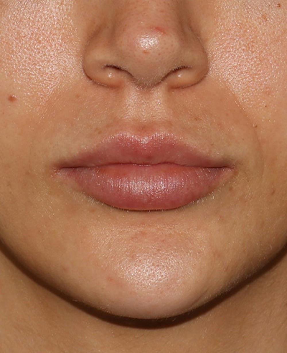 Lip Filler Before & After Gallery - Patient 359064 - Image 2