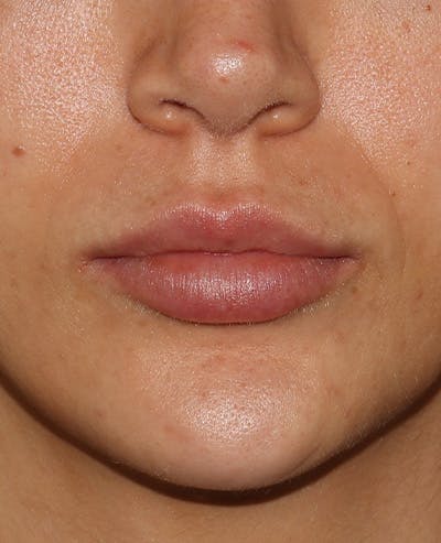 Lip Filler Before & After Gallery - Patient 359064 - Image 2