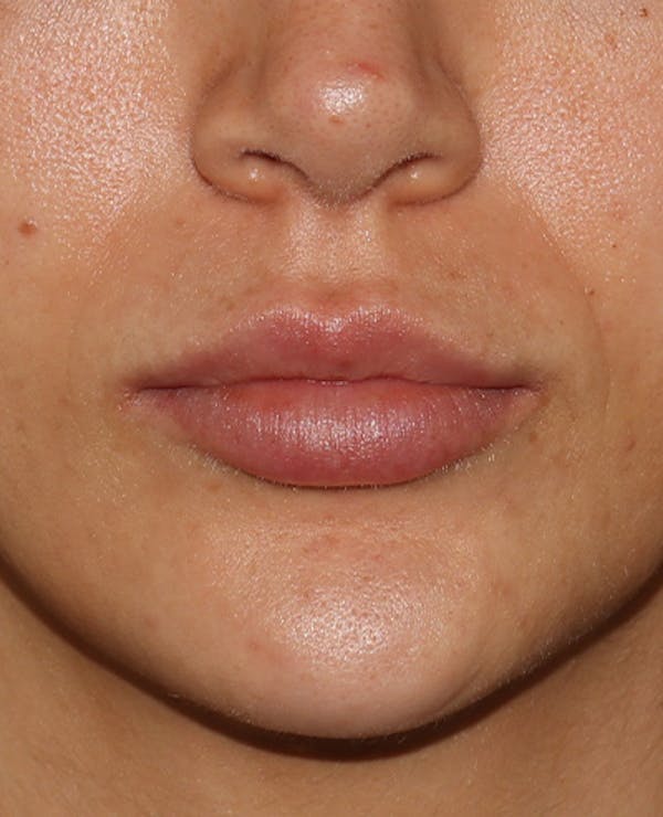 Lip Filler Before & After Gallery - Patient 359064 - Image 2