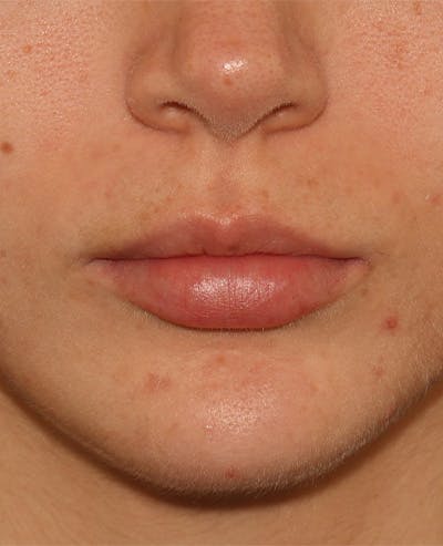 Lip Filler Before & After Gallery - Patient 359064 - Image 1