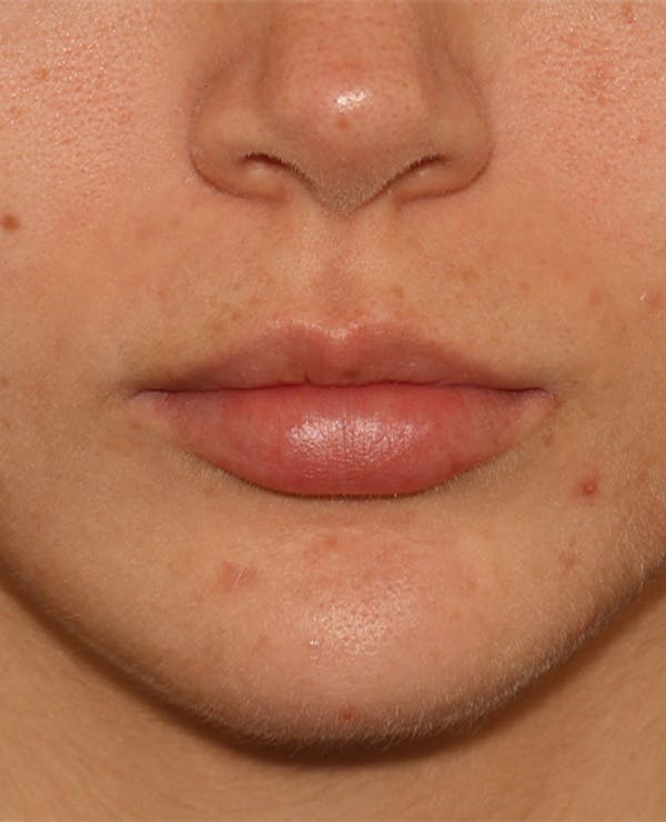 Lip Filler Before & After Gallery - Patient 359064 - Image 1