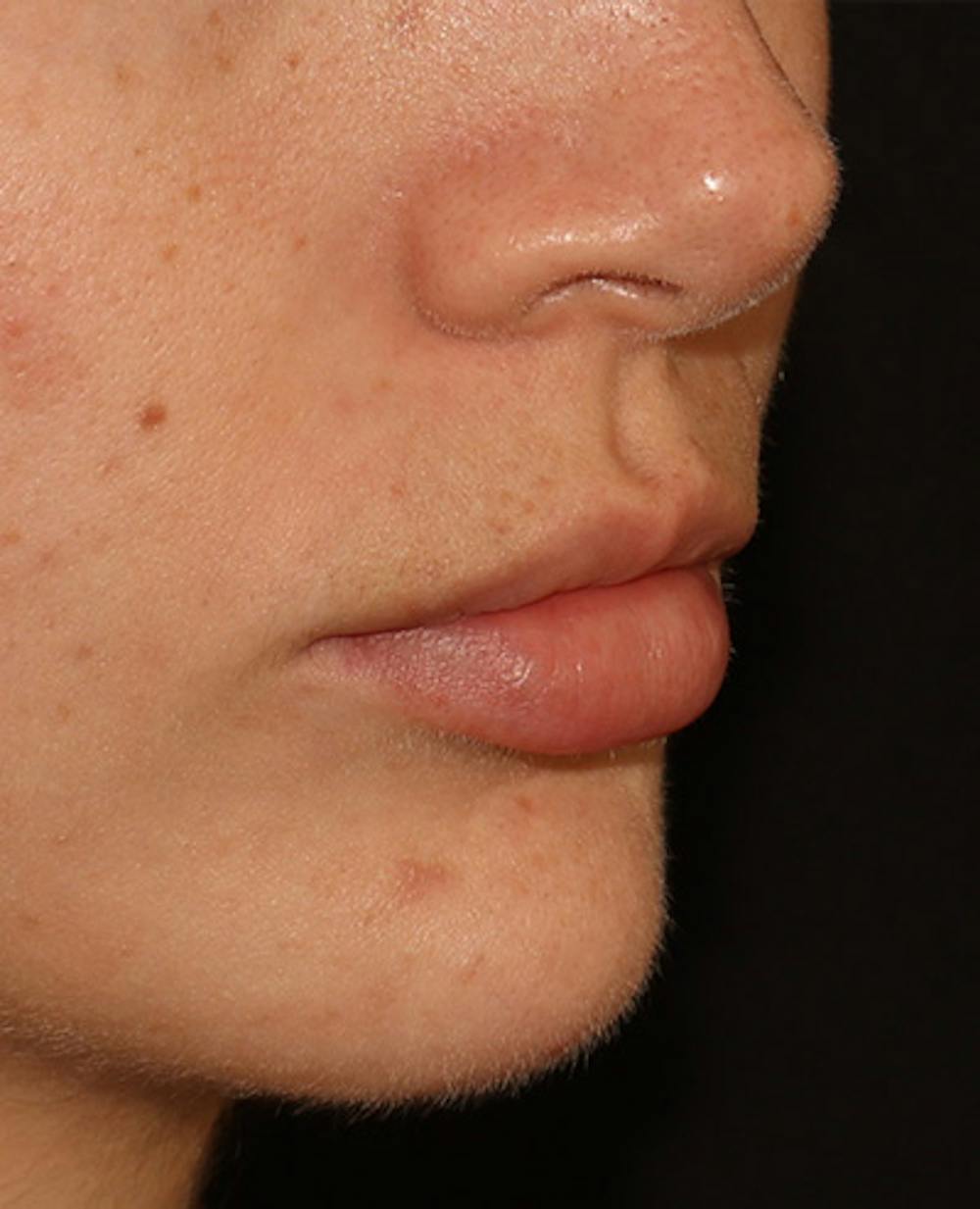 Lip Filler Before & After Gallery - Patient 359064 - Image 3
