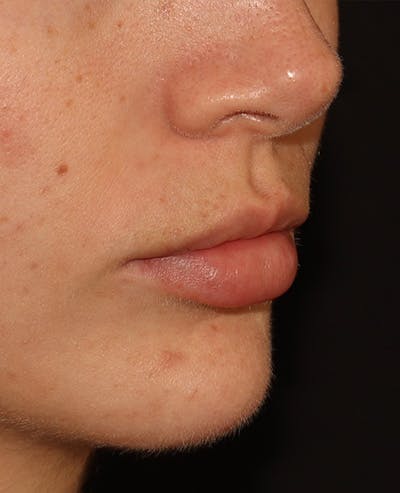 Lip Filler Before & After Gallery - Patient 359064 - Image 3