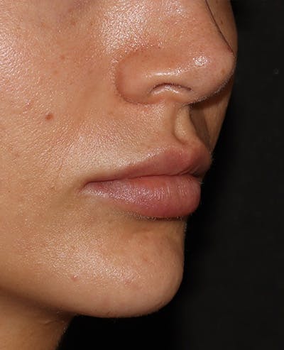 Lip Filler Before & After Gallery - Patient 359064 - Image 4