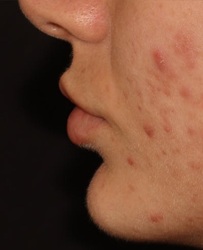 Lip Filler Before & After Gallery - Patient 359064 - Image 5