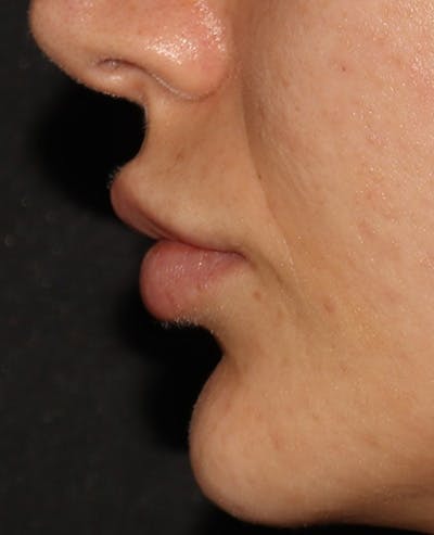 Lip Filler Before & After Gallery - Patient 359064 - Image 6