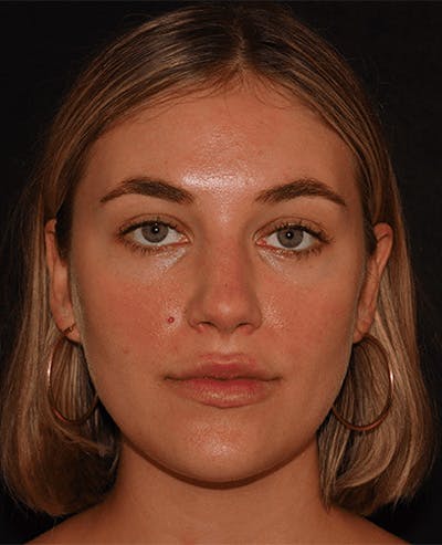 Lip Filler Before & After Gallery - Patient 141186444 - Image 1