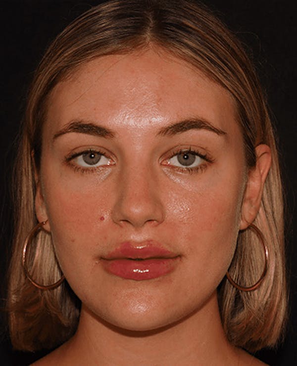 Lip Filler Before & After Gallery - Patient 141186444 - Image 2
