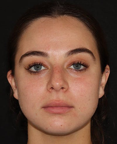 Lip Filler Before & After Gallery - Patient 141186406 - Image 1