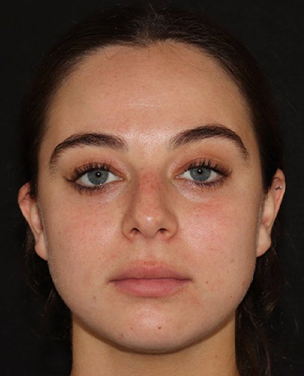 Lip Filler Before & After Gallery - Patient 141186406 - Image 1