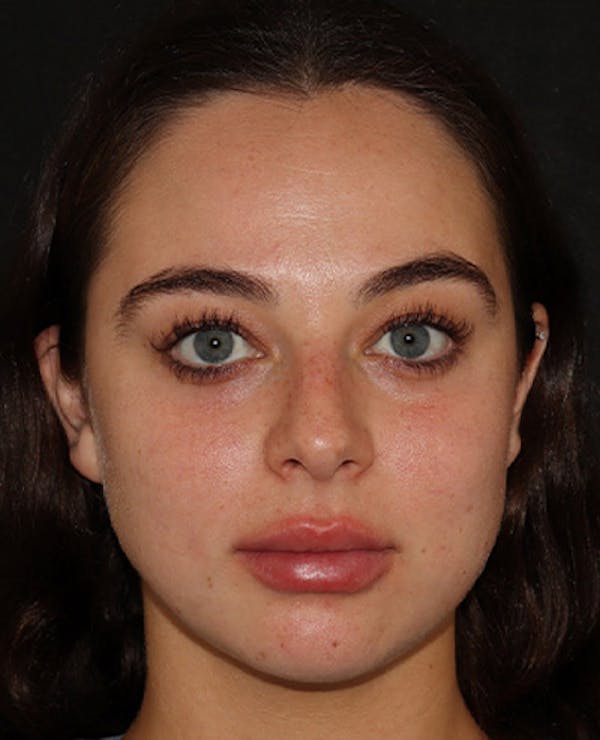 Lip Filler Before & After Gallery - Patient 141186406 - Image 2