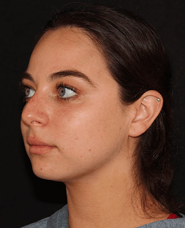 Lip Filler Before & After Gallery - Patient 141186406 - Image 3