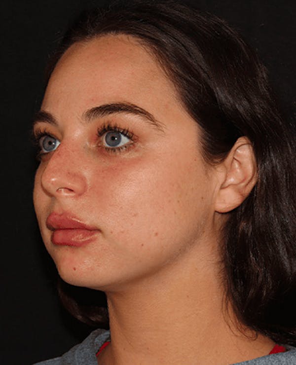 Lip Filler Before & After Gallery - Patient 141186406 - Image 4