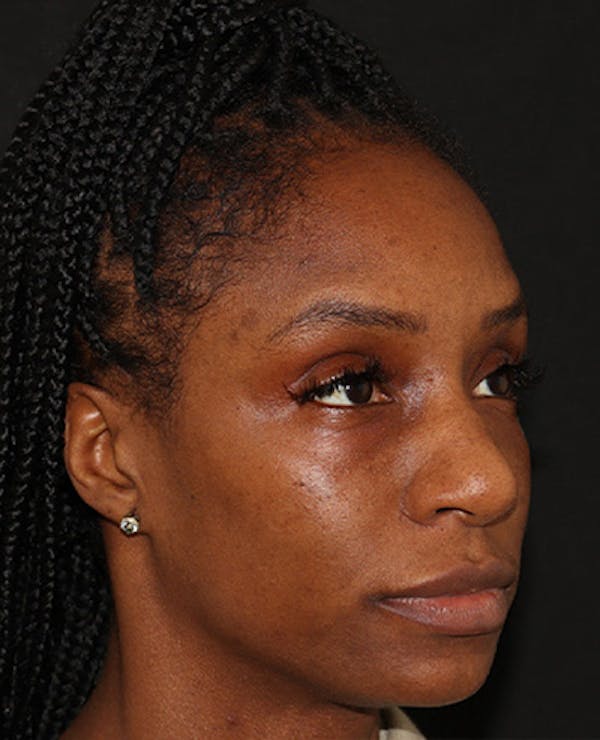 Lip Filler Before & After Gallery - Patient 141186408 - Image 1