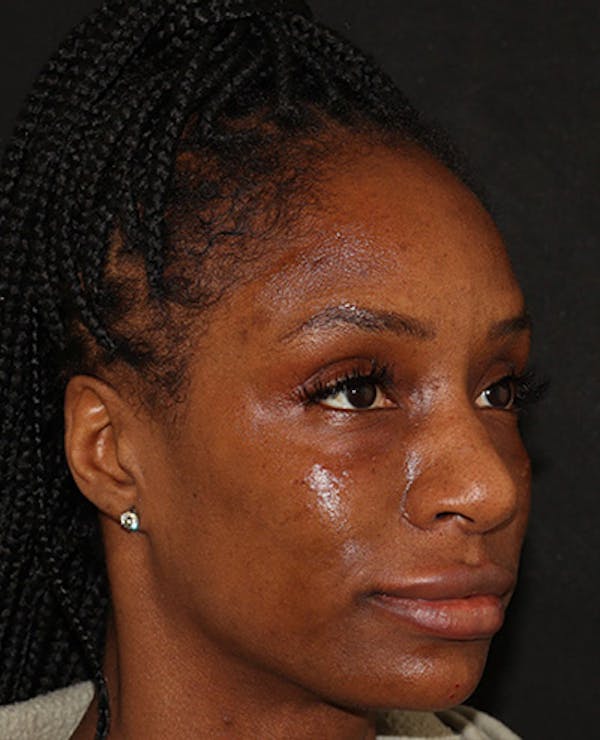 Lip Filler Before & After Gallery - Patient 141186408 - Image 2