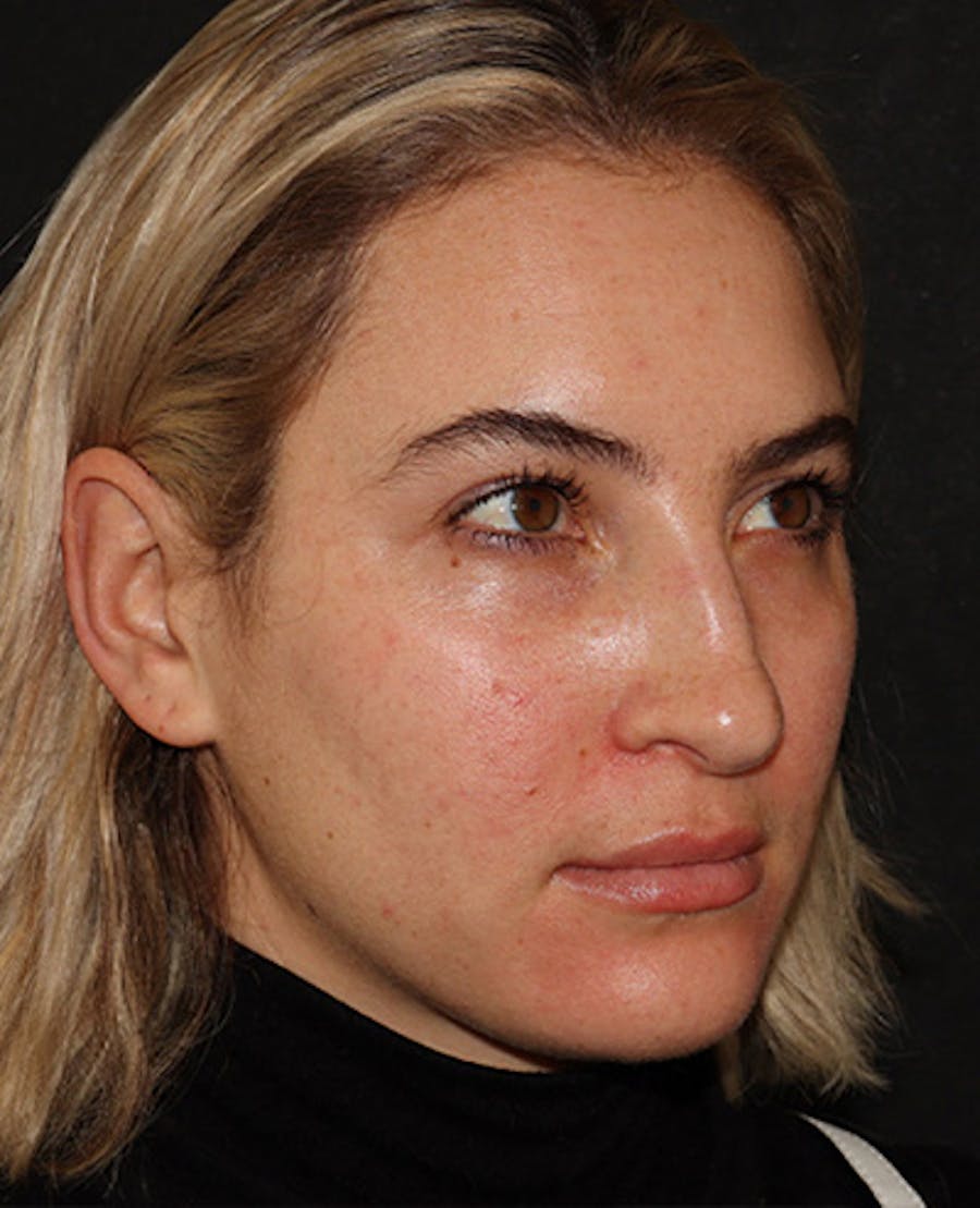 Lip Filler Before & After Gallery - Patient 141186423 - Image 1