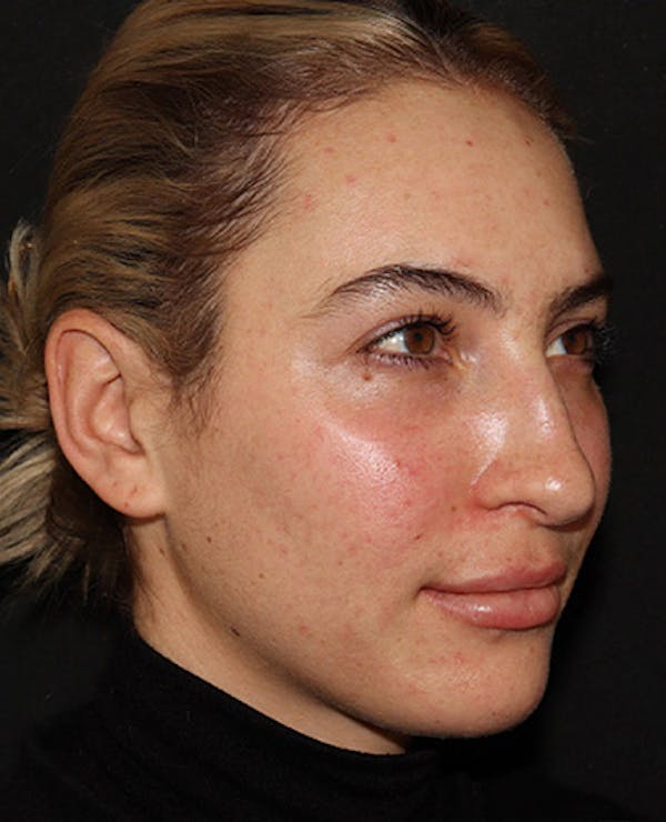 Lip Filler Before & After Gallery - Patient 141186423 - Image 2