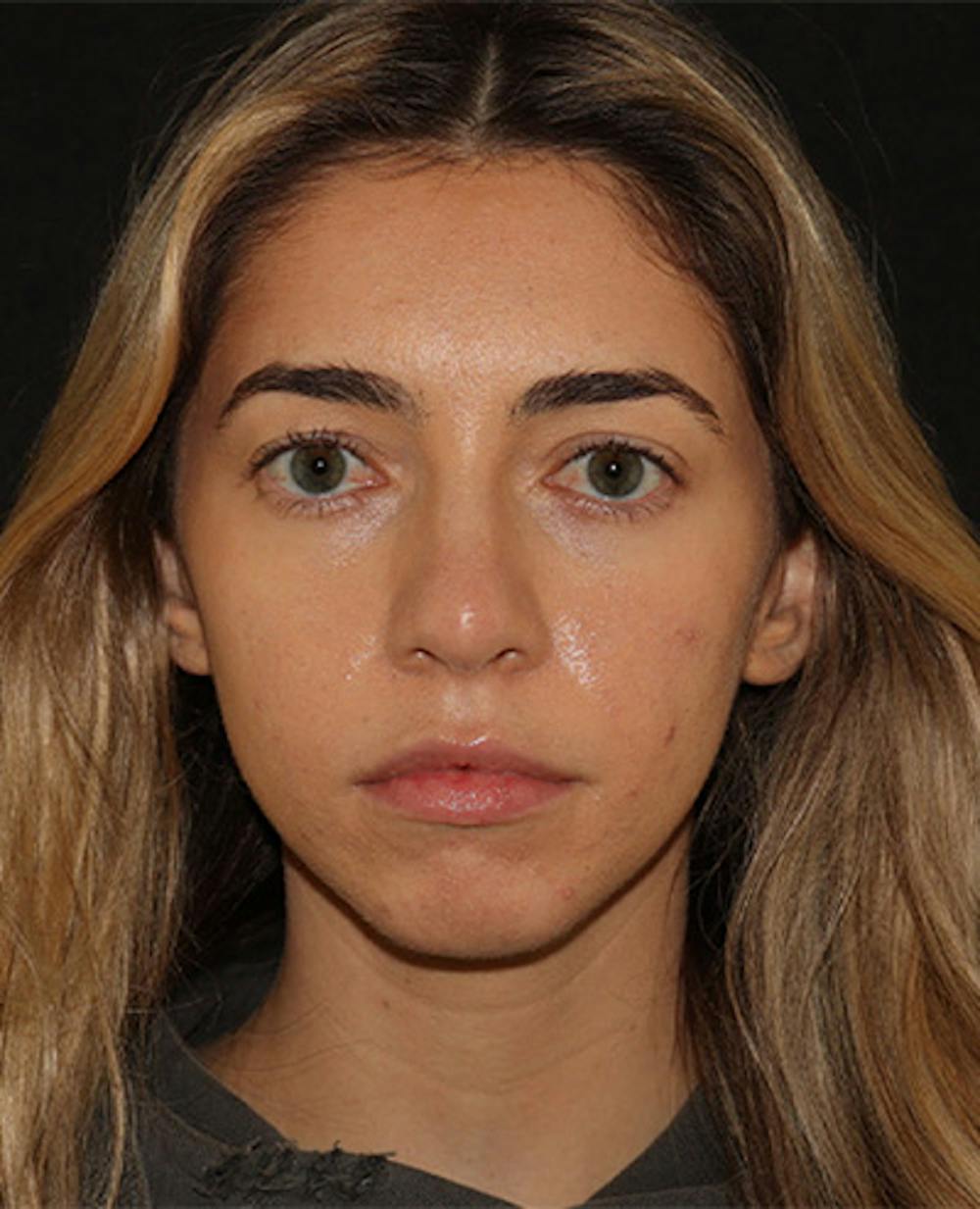 Lip Filler Before & After Gallery - Patient 141186428 - Image 1