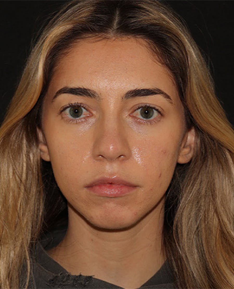 Lip Filler Before & After Gallery - Patient 141186428 - Image 1