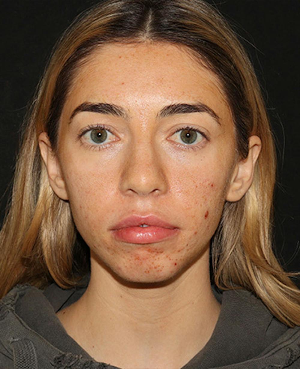 Lip Filler Before & After Gallery - Patient 141186428 - Image 2