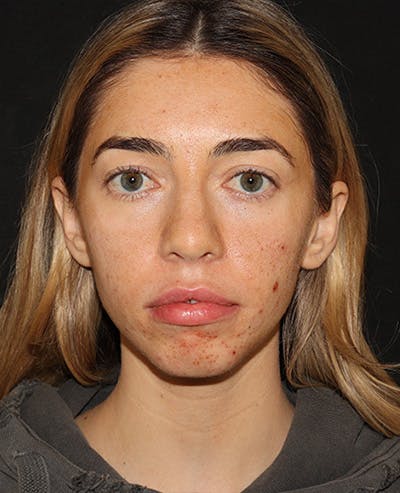 Lip Filler Before & After Gallery - Patient 141186428 - Image 2