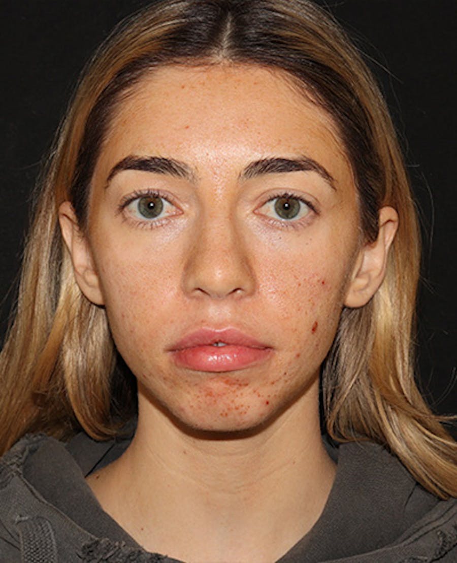 Lip Filler Before & After Gallery - Patient 141186428 - Image 2