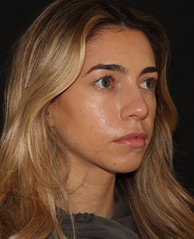 Lip Filler Before & After Gallery - Patient 141186428 - Image 3
