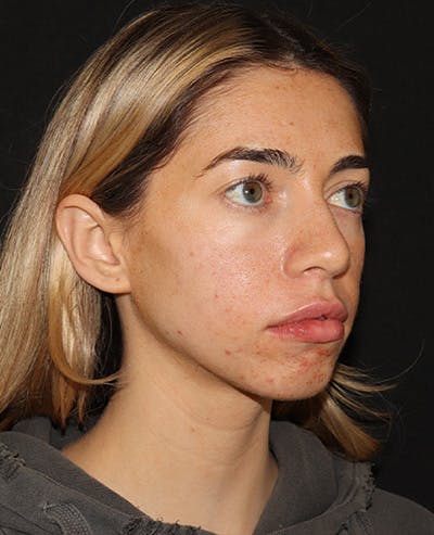 Lip Filler Before & After Gallery - Patient 141186428 - Image 4