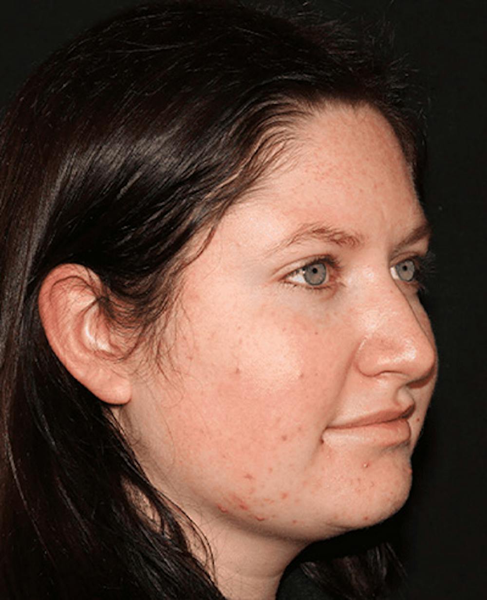 Lip Filler Before & After Gallery - Patient 141186434 - Image 5