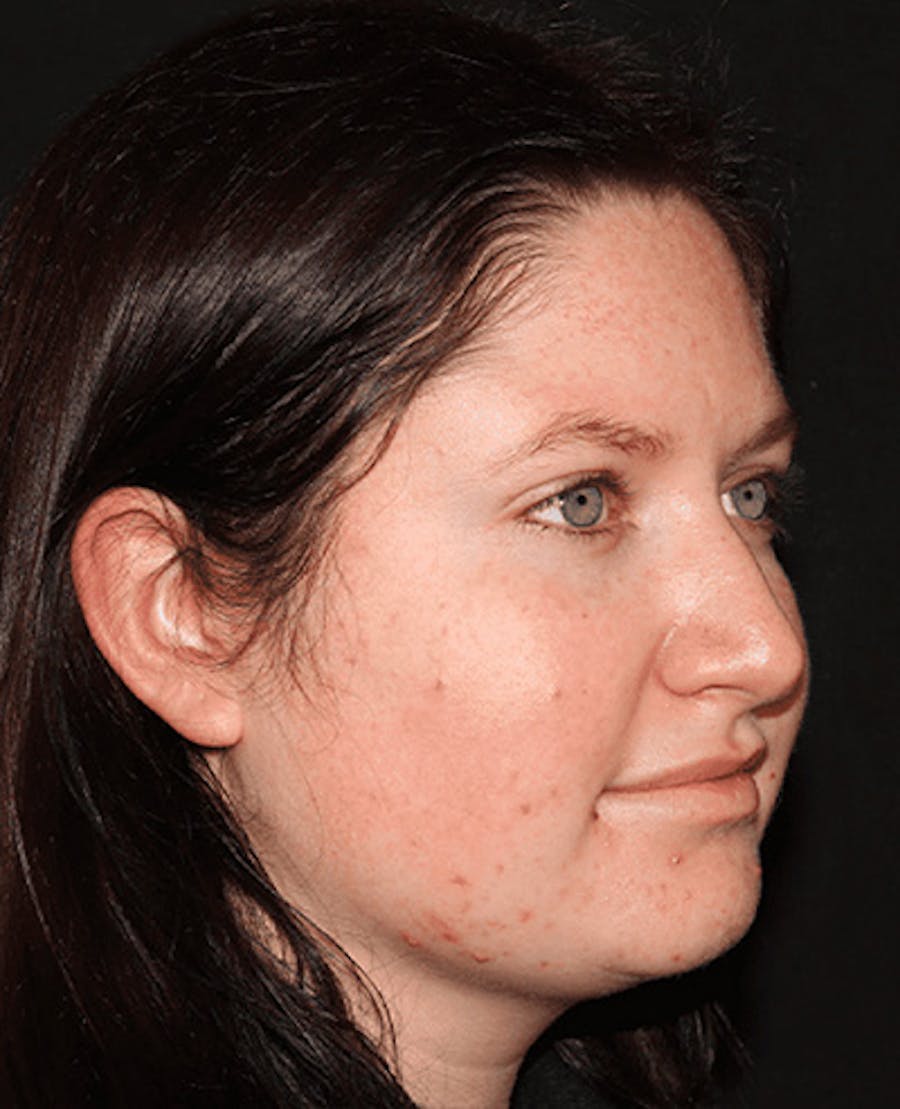 Lip Filler Before & After Gallery - Patient 141186434 - Image 5