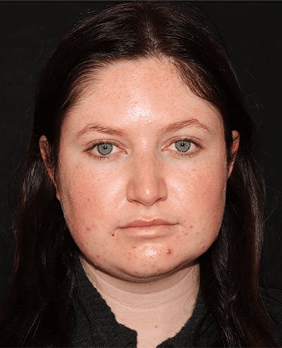Lip Filler Before & After Gallery - Patient 141186434 - Image 1