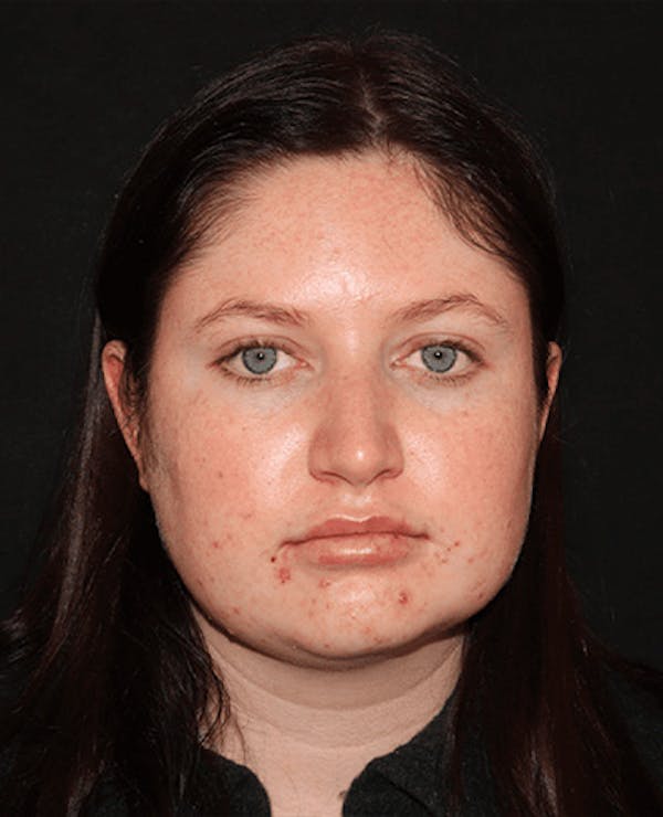 Lip Filler Before & After Gallery - Patient 141186434 - Image 2