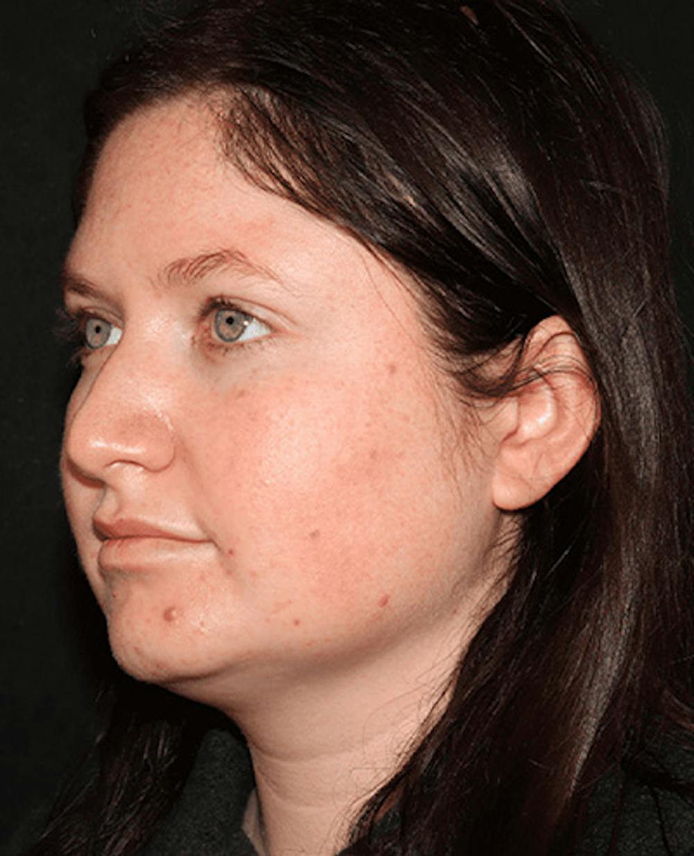 Lip Filler Before & After Gallery - Patient 141186434 - Image 3