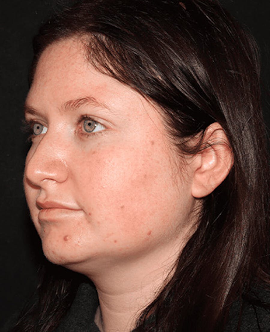 Lip Filler Before & After Gallery - Patient 141186434 - Image 3