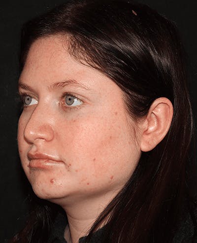 Lip Filler Before & After Gallery - Patient 141186434 - Image 4