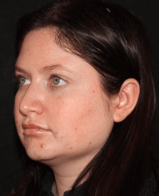 Lip Filler Before & After Gallery - Patient 141186434 - Image 4